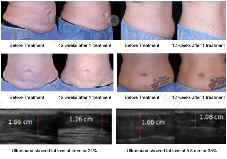 hot monopolar rf skin tightening trusculpt