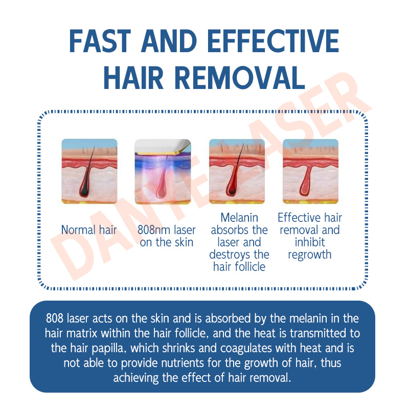 hair laser removal