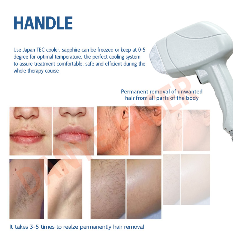 laser hair removal laser hair