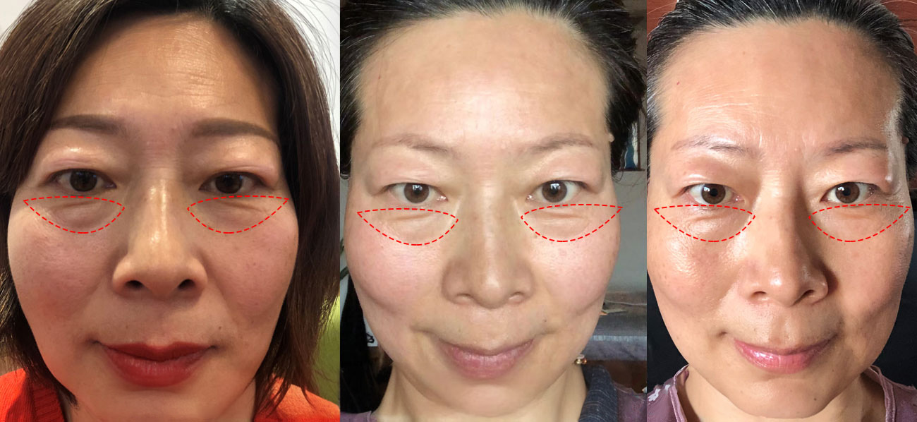 radio frequency wrinkle removal