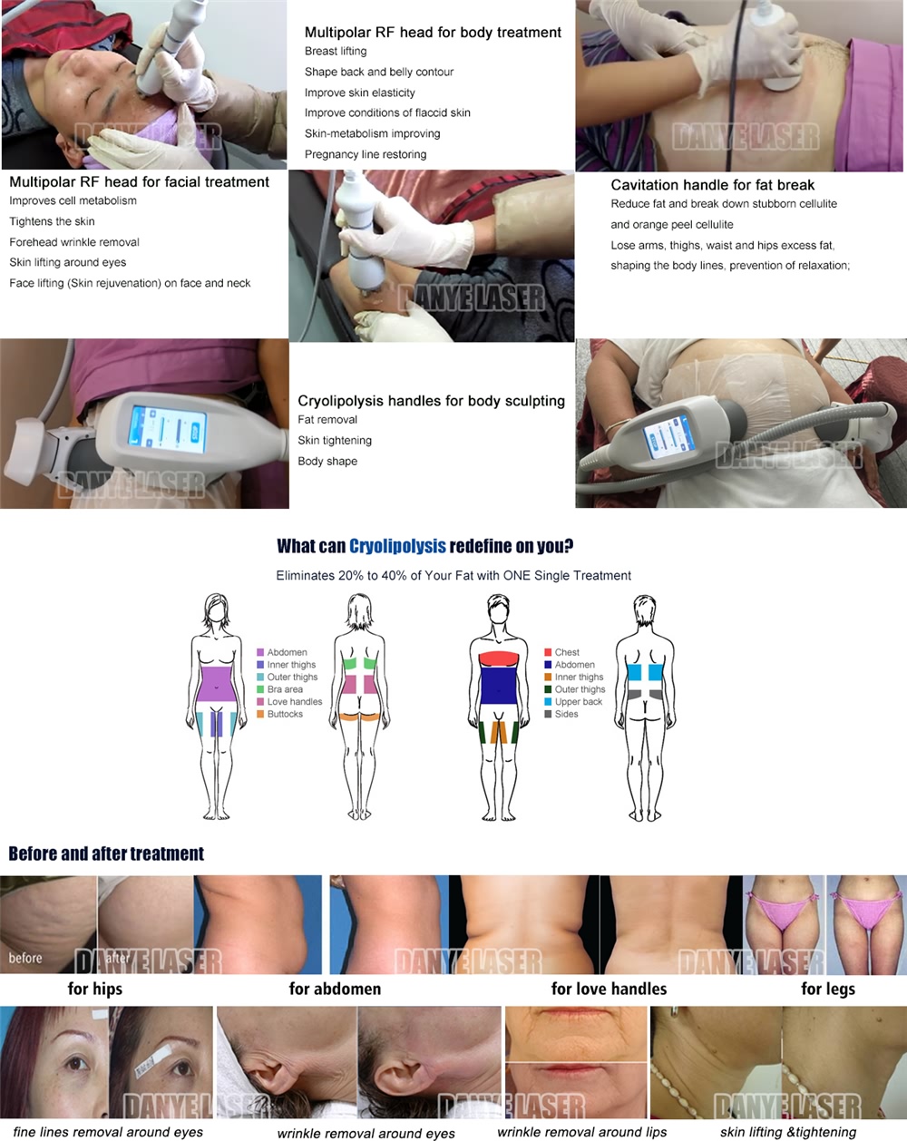 NEW 360 Cryolipolysis Vacuum 4 in 1 Platform (2)