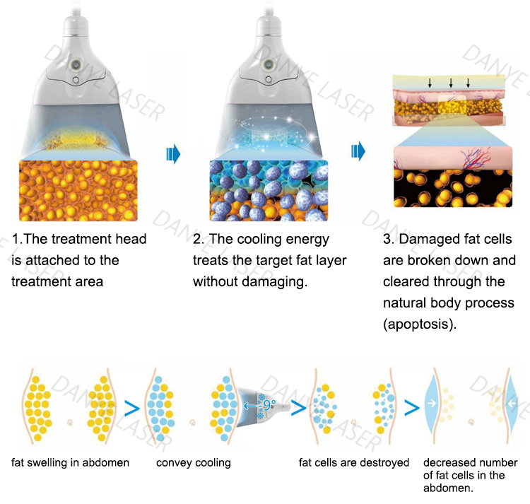 360 cryo fat freeze  Working Principle