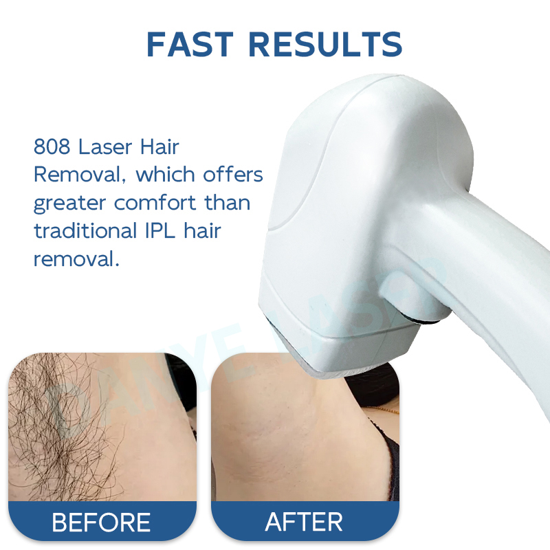 laser diode hair removal